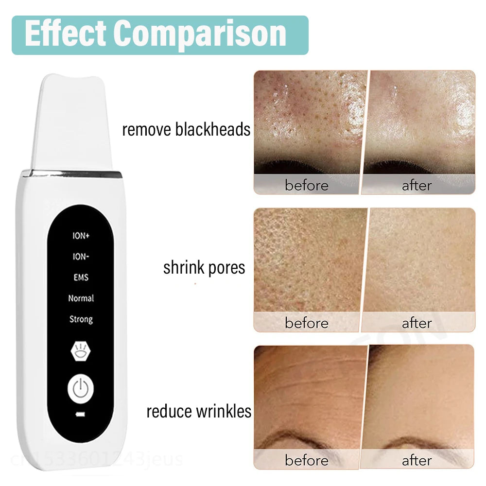 Ultrasonic Skin Scrubber Peeling Blackhead Remover Deep Face Cleaning Ultrasonic Ion Ance Pore Cleaner Facial Shovel Cleanser